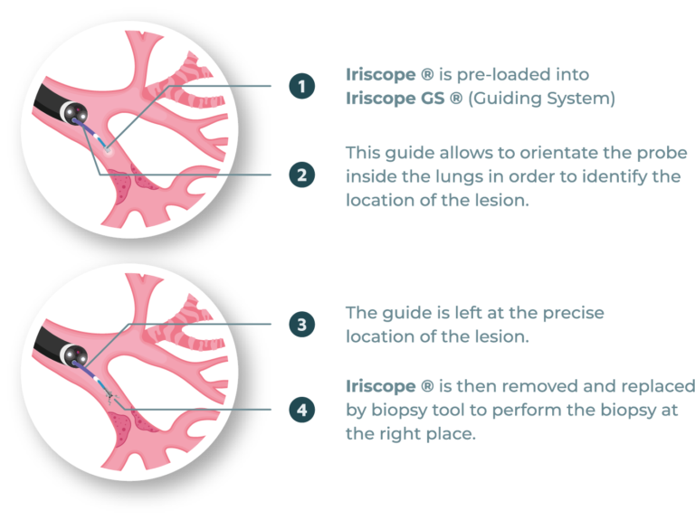 Iriscope principle